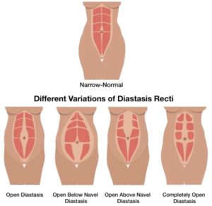 Diastasis diagram of different versions